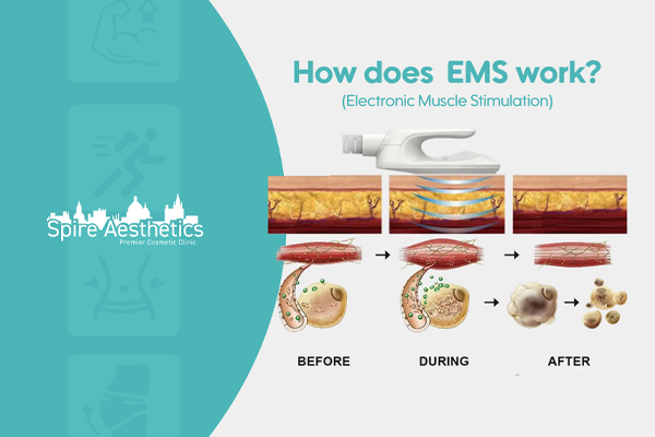 EMS treatment for post pregnancy weight loss treatment Bishops Stortford
