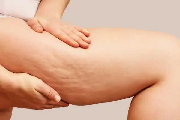Image of woman showing leg with cellulite Bishops Stortford