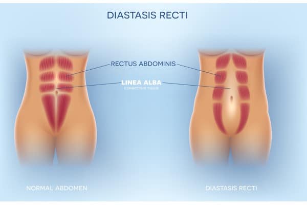 What Non-Surgical Options Are Available for Diastasis Recti Bishops Stortford?