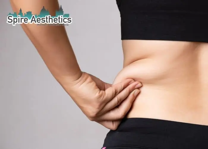 Image of woman pinching fat on their hips Bishops Stortford. Fat Freezing treatment