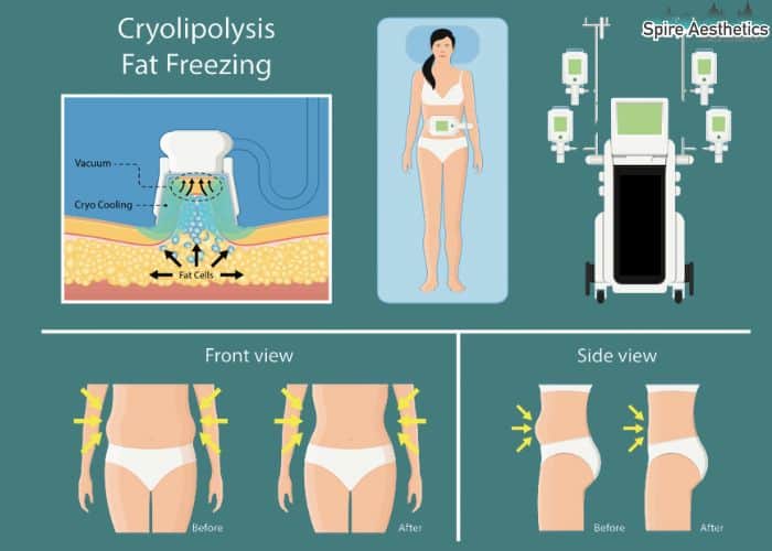 Image of diet and fat freezing combined for best results for Spire Aesthetics Bishops Stortford