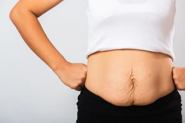 Image of a woman's stomach after weight loss with sagging skin following a gastric band Bishops Stortford