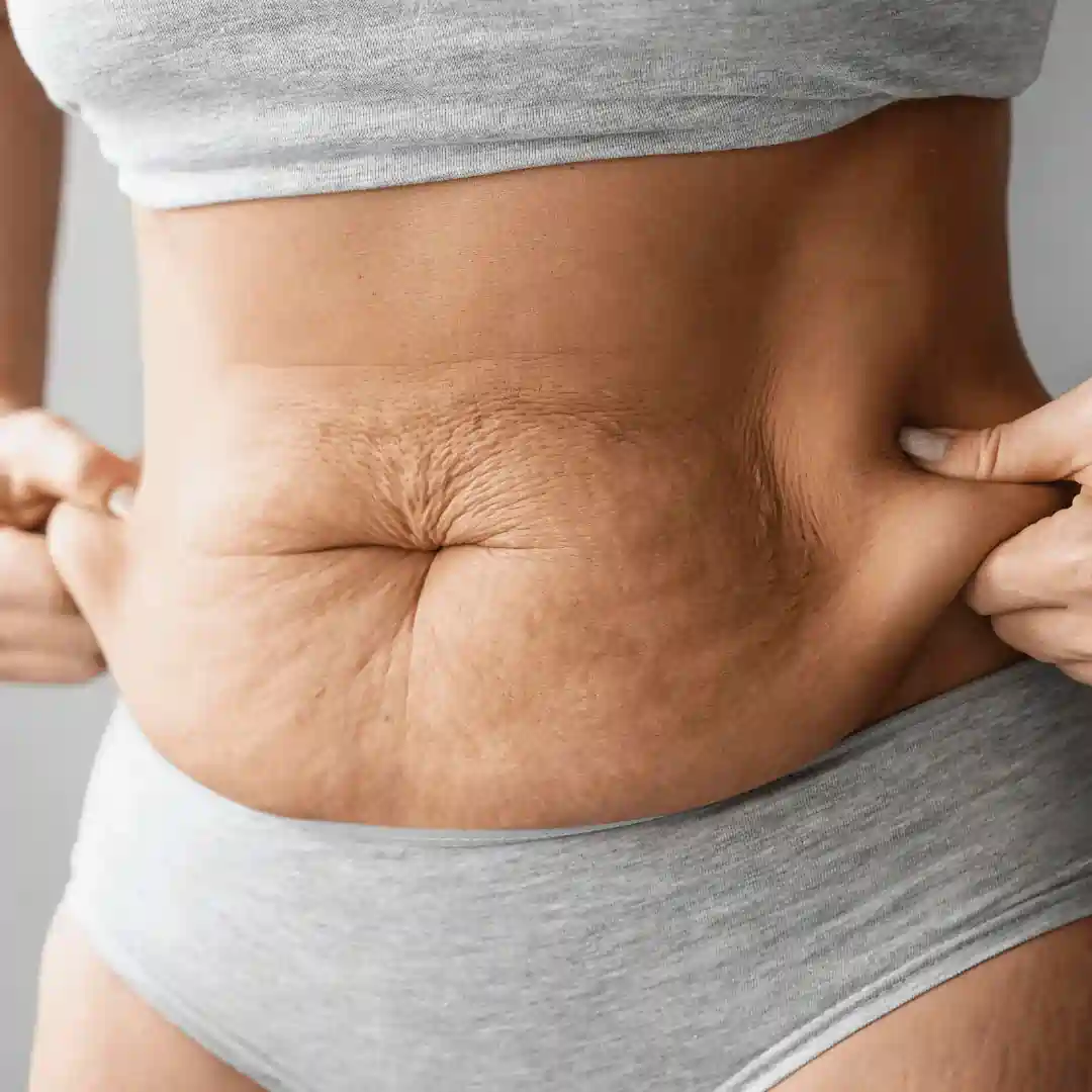 Is It Normal to Have Loose Skin After Pregnancy Bishops Stortford?