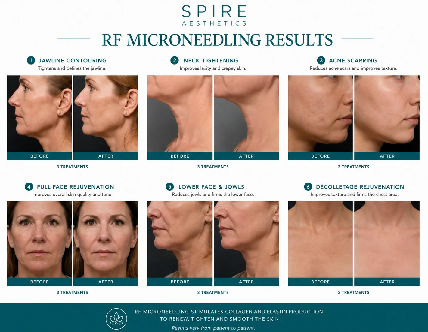 RF Microneedling Skin tightening Bishops Stortford results
