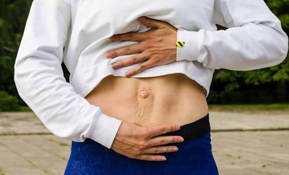 When Could Diastasis Recti Be the Missing Piece of the Puzzle Bishops Stortford?