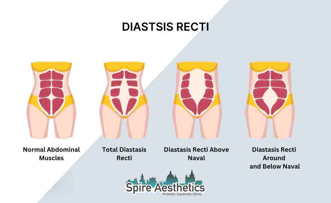 Is Non-Surgical Diastasis Recti Treatment Right for You? Common Concerns Answered Bishops Stortford